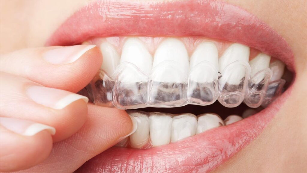Alinhadores Invisíveis: O Caminho Discreto para um Sorriso Perfeito
