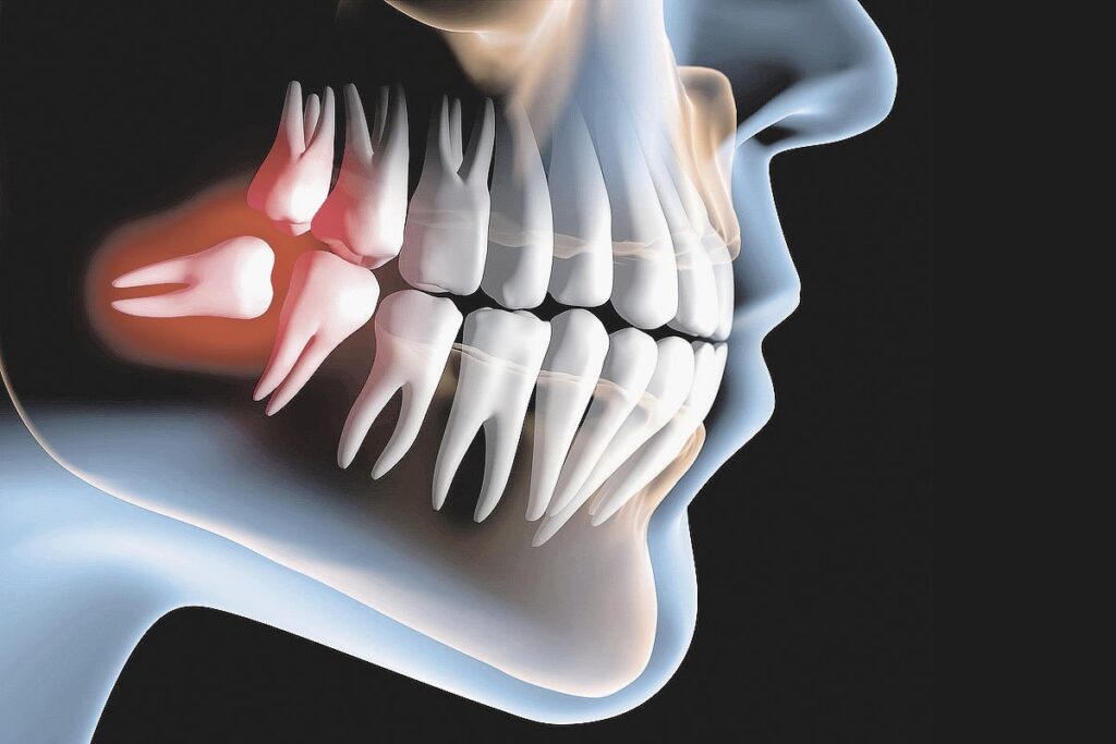 É obrigatória a extração dos dentes do siso?
