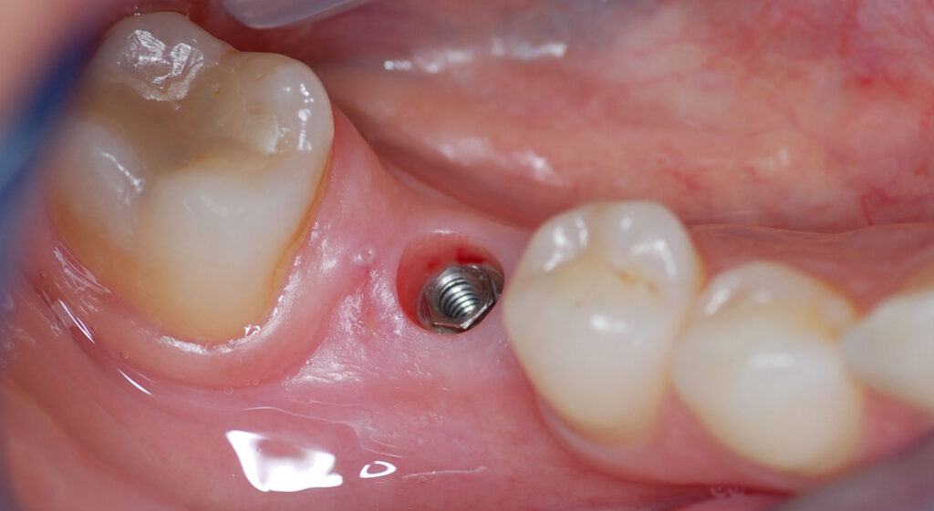 Implantes Dentários: Quando e Como Funcionam?
